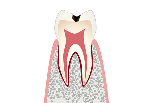 エナメル質に小さな穴が空いた虫歯のイラスト