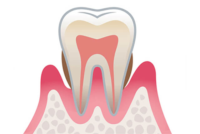 中度歯周病のイラスト