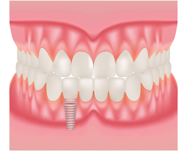 インプラントのイラスト2