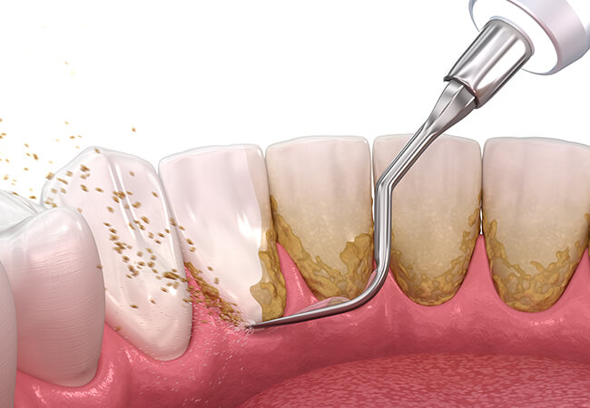 スケーリング(歯石取り)