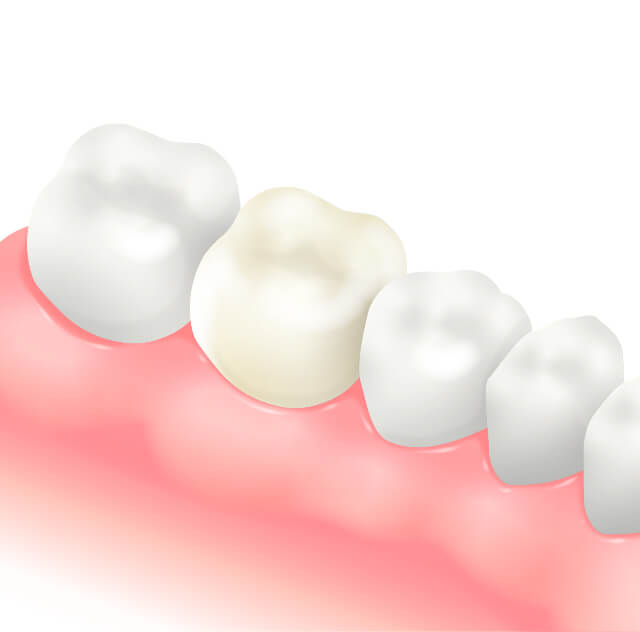 フッ素塗布イメージイラスト